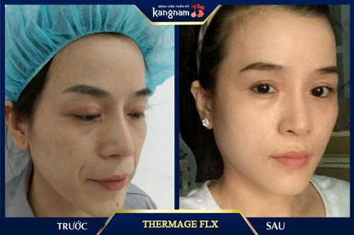 Kết quả trước và sau khi thực hiện trẻ hóa da bằng công nghệ Thermage FLX tại b bệnh viện thẩm mỹ Kangnam 