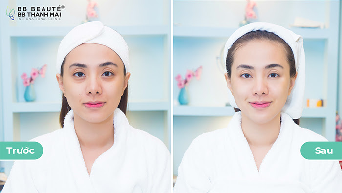 Sự thay đổi rõ rệt về làn da của khách hàng sau khi thực hiện trẻ hoá da tại BB Beauté – BB Thanh Mai 
